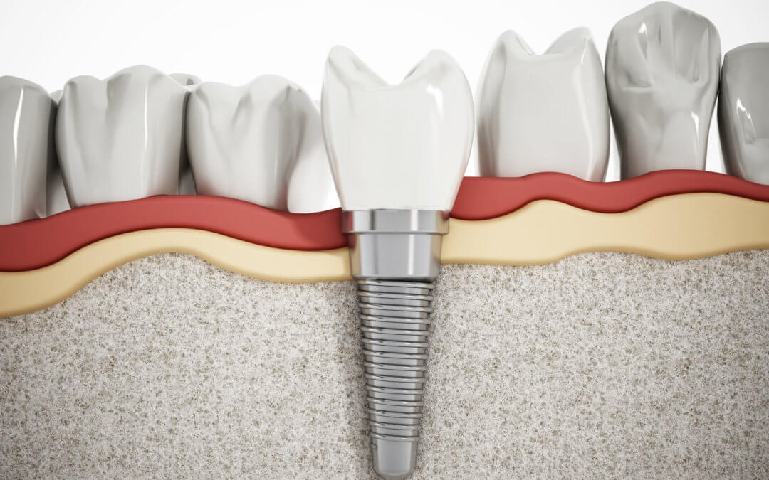 The Complete Guide to Choosing an Implant Dentist: Everything to Know