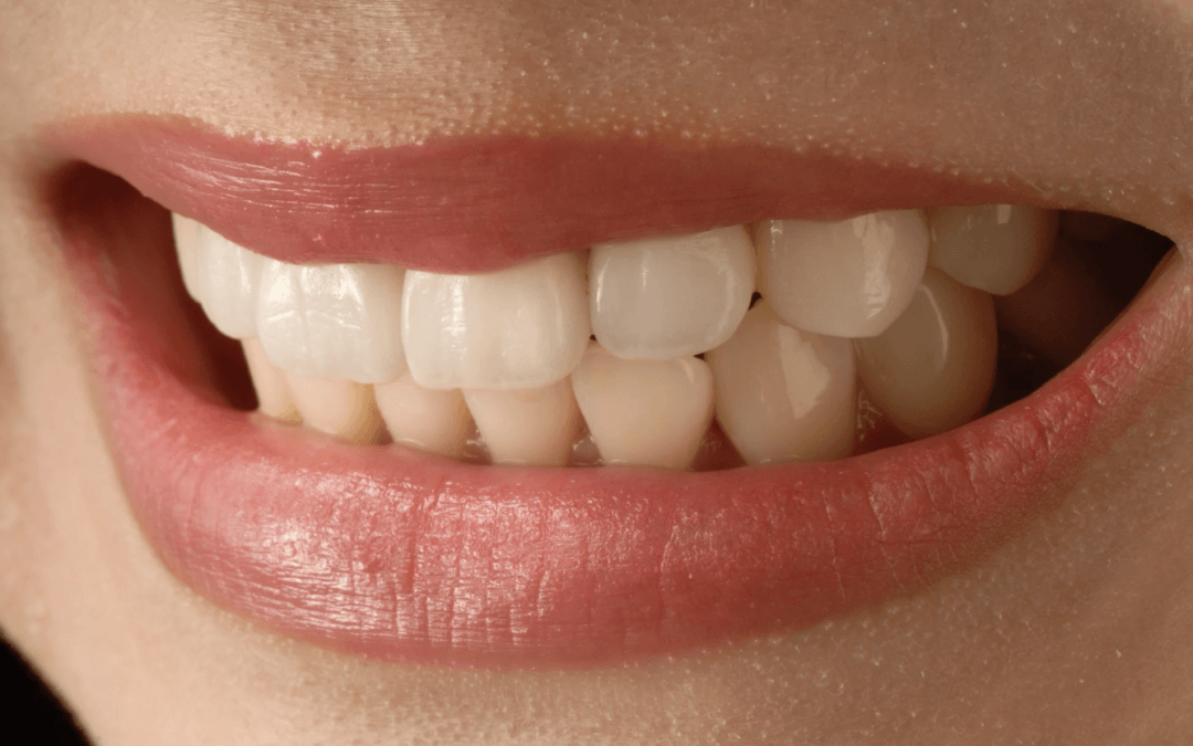 Are Veneers Permanent? Everything You Need to Know About Veneers